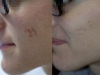 cicatrice-depressa-dopo-laser-frazionato