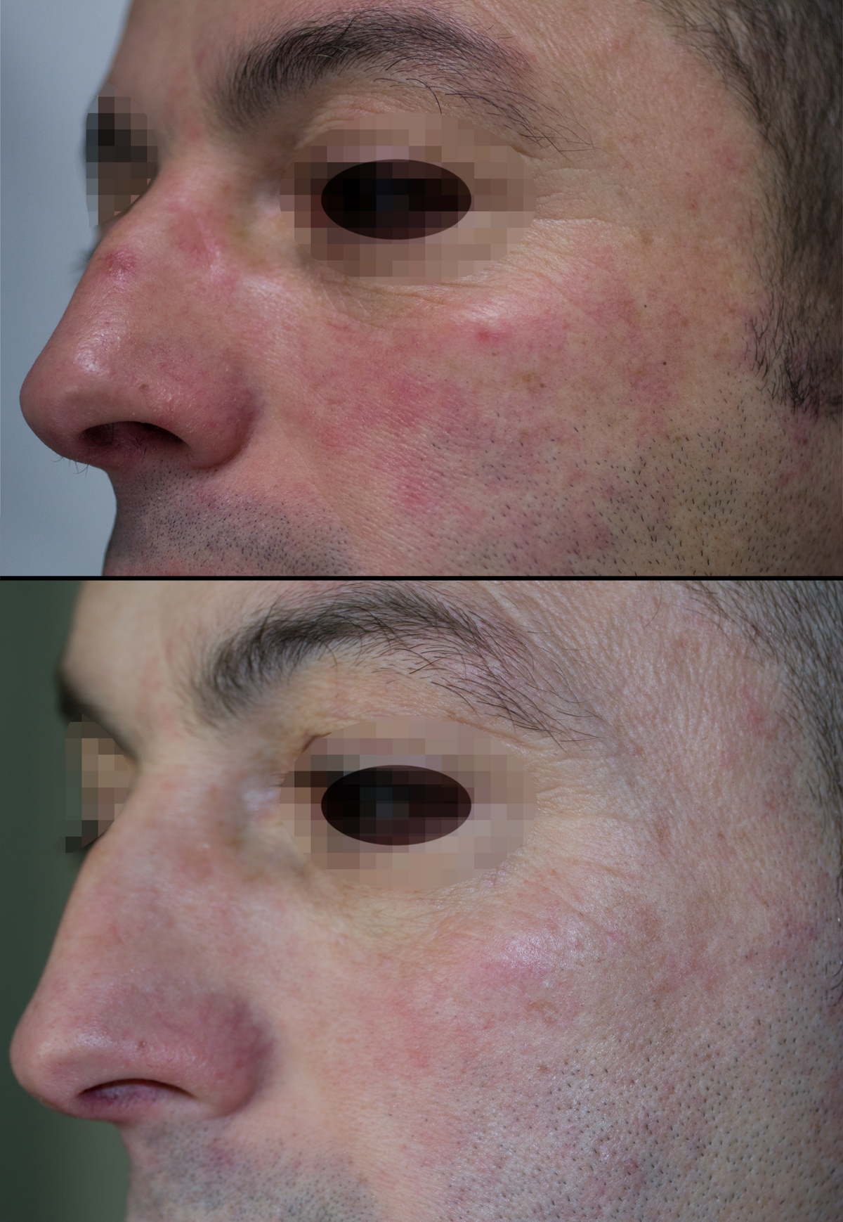Capillari Viso Laser