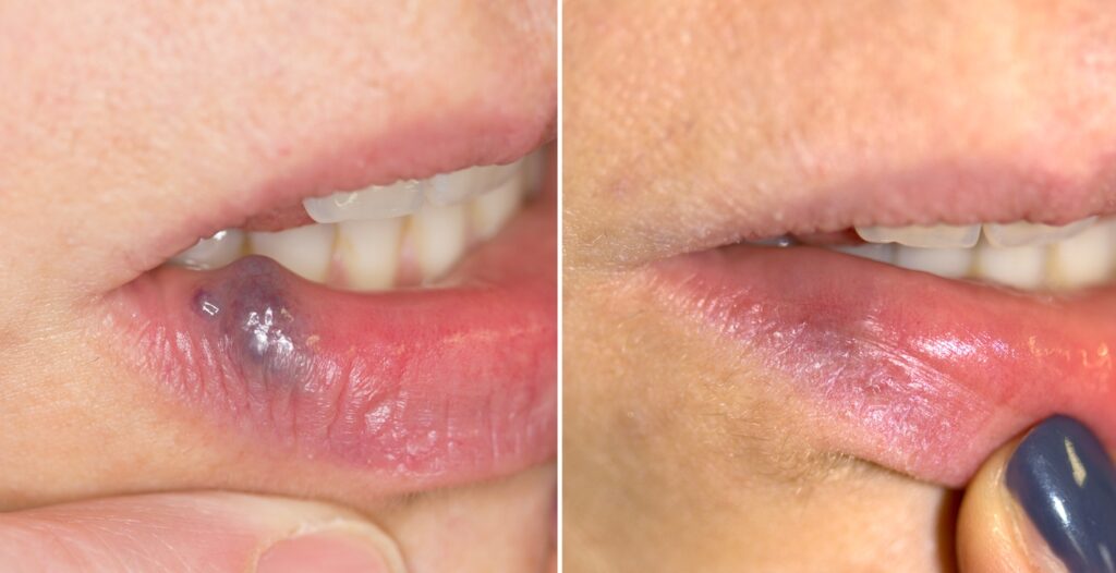 Laghi venosi, rimozione con laser prima e dopo - Dr. Davide Brunelli