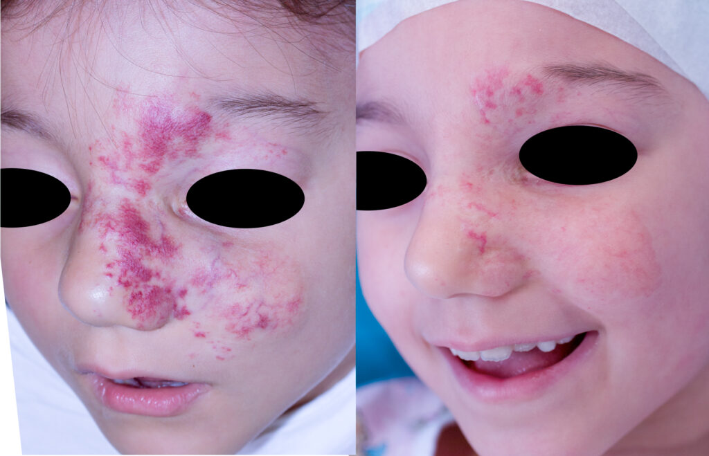 Pre e post trattamento laser angioma viso - Dott. Davide Brunelli