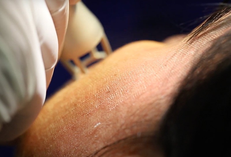Laser CO2 frazionato - applicato al viso, Dermatologo Brunelli