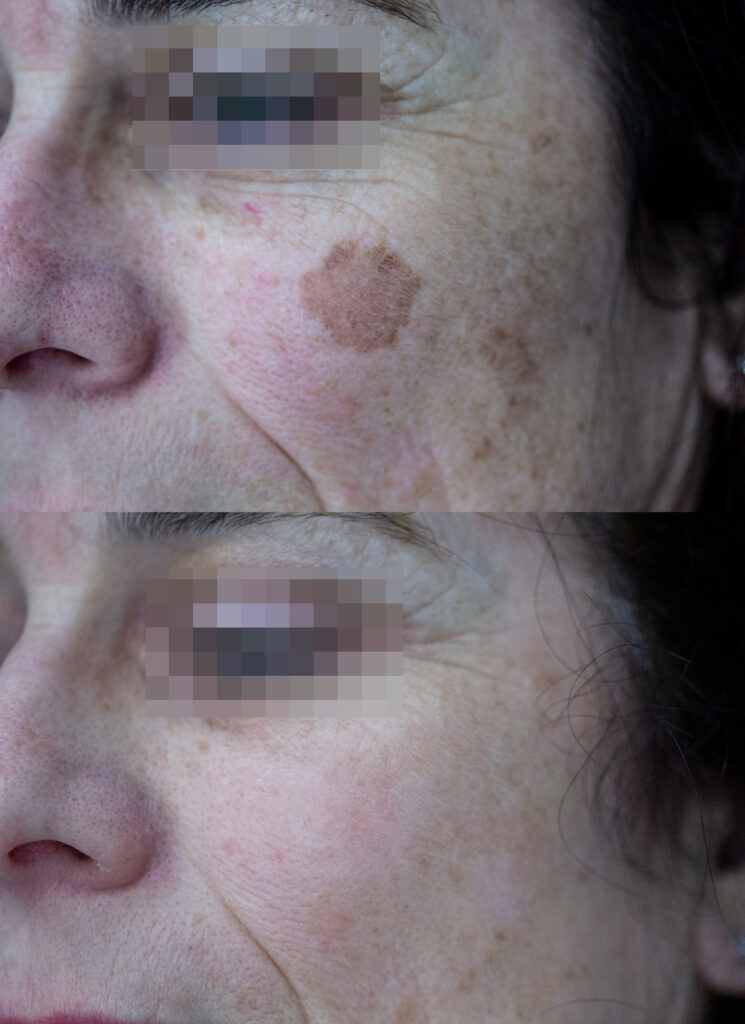 Lentiggini solari: prima e dopo il laser - Dr. Davide Brunelli