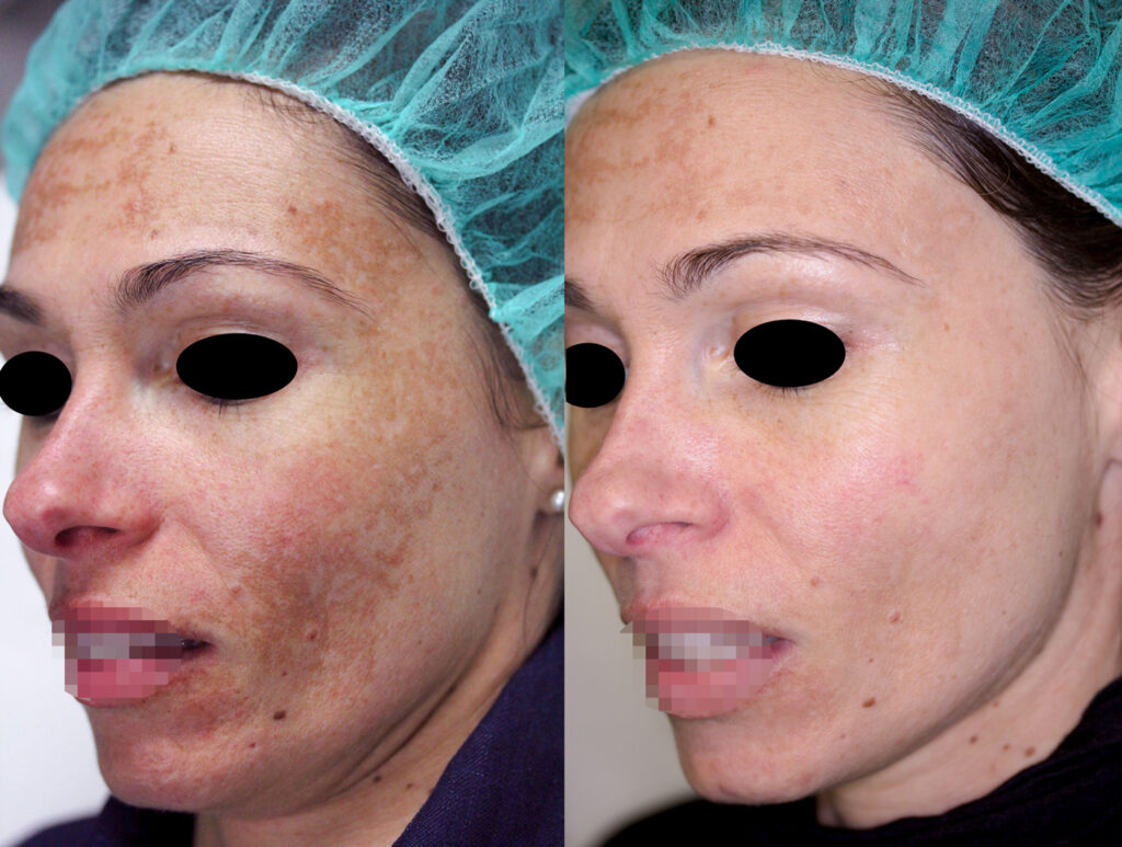 Melasma trattato con laser Q-Switched, Dott. Brunelli