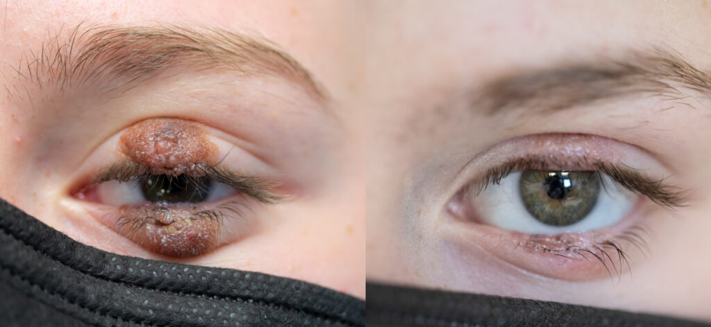 Neo melanocitico: rimozione con laser CO2 - prima e dopo Dr. Brunelli