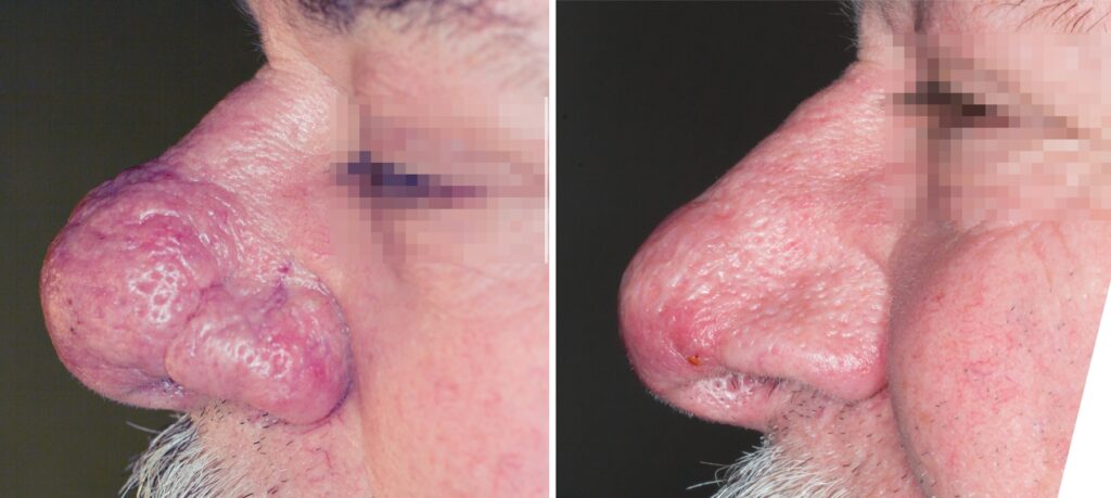 Rinofima trattamento laser - Dott. Brunelli, Rimini e Cesena