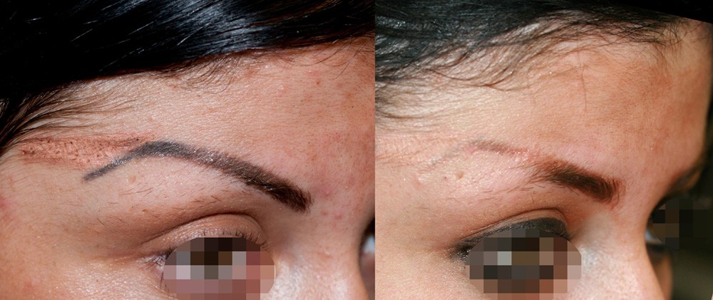 Tatuaggio sopracciglia, cancellazione con laser a Rimini e Cesena, Dr. Brunelli